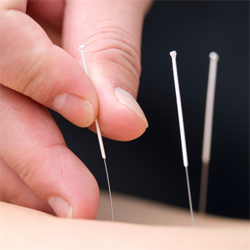 Close up of acupuncture needles being placed